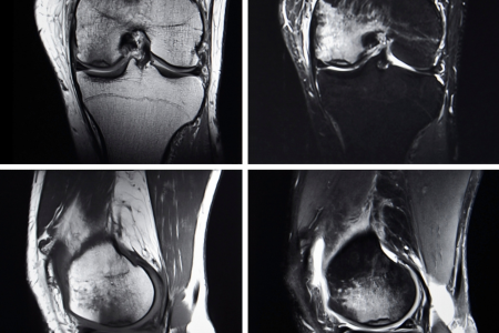 変形性膝関節症　MRI