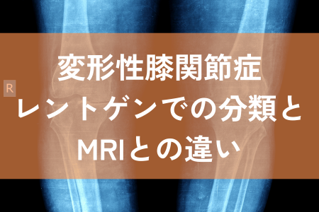 変形性膝関節症　レントゲン