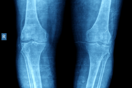 変形性膝関節症　MRI
