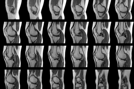 変形性膝関節症　MRI
