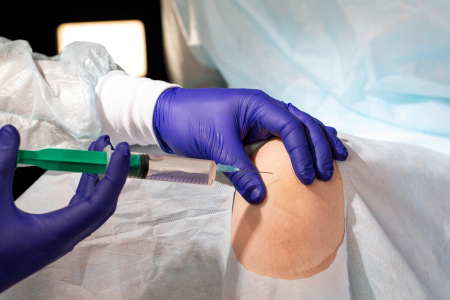 変形性膝関節症　30代