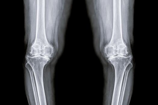 変形性膝関節症　歩き始めの痛み