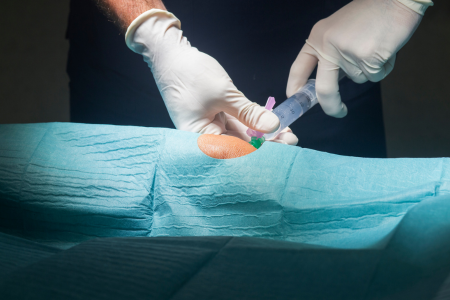 変形性膝関節症　膝に水が溜まる